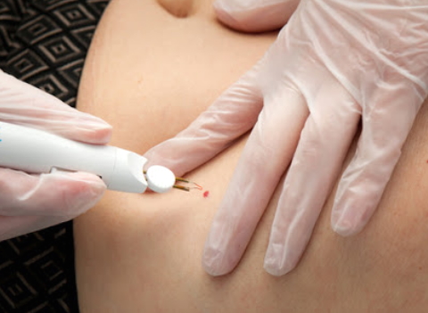 Couperose & vaatjes bij HuidKliniek Oss in Oss