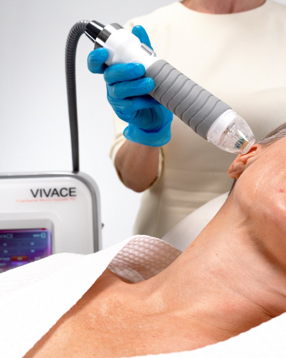 Vivace RF-microneedling bij HuidKliniek Oss in Oss